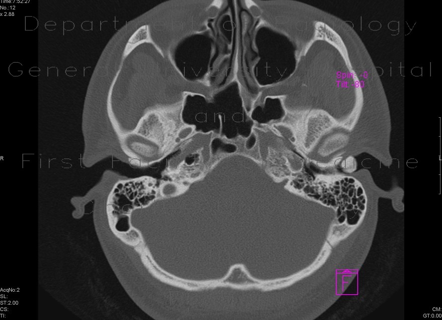 external auditory meatus x ray