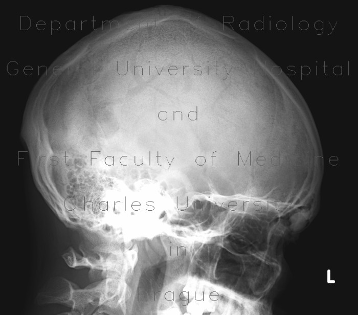 Osteoma of frontal sinus