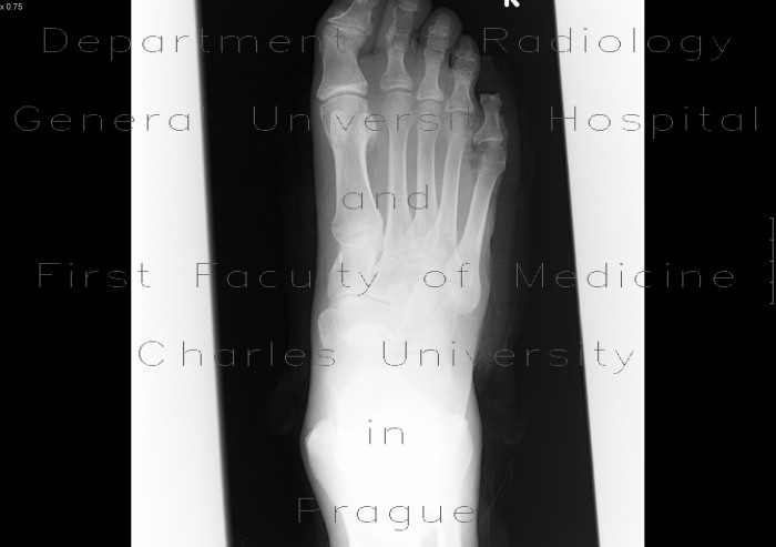 Osteomyelitis of fifth metatarsal bone