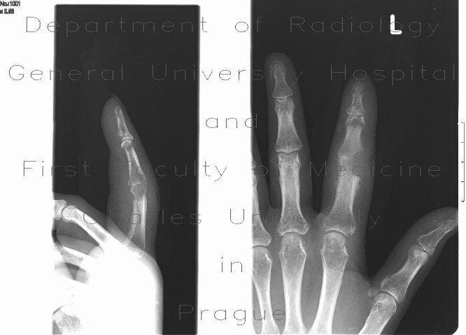 Osteomyelitis of finger