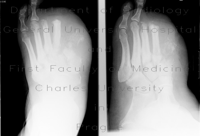 Osteomyelitis of metatarsal bones