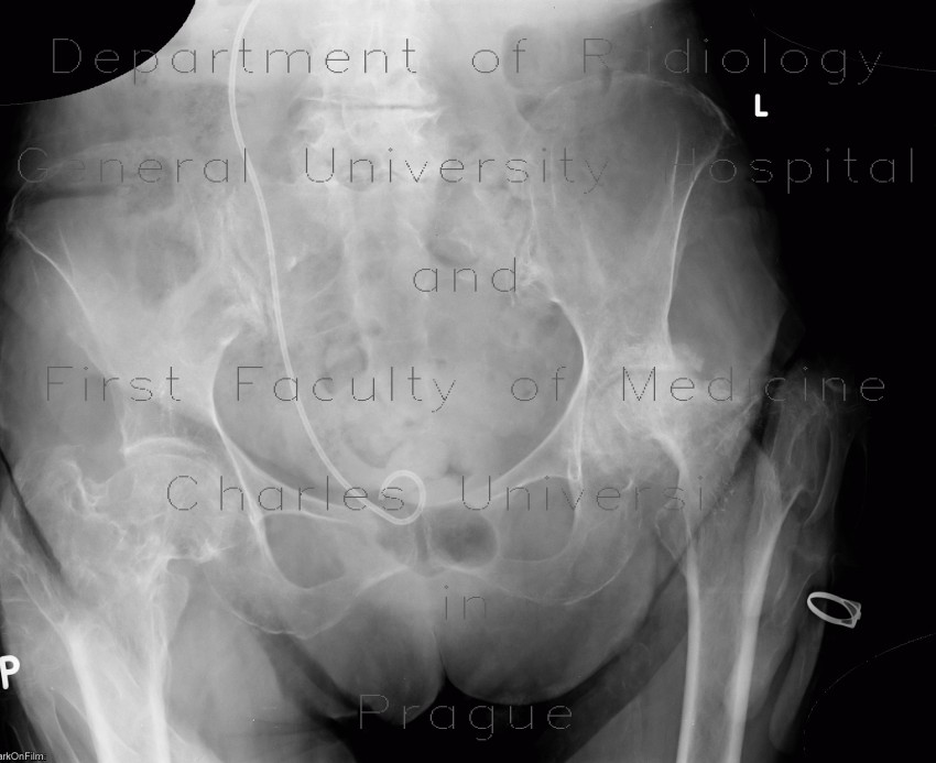 Radiology image - Osteonecrosis of femoral head, osteoarthrosis: Extremity, Bone: X-ray - Plain radiograph