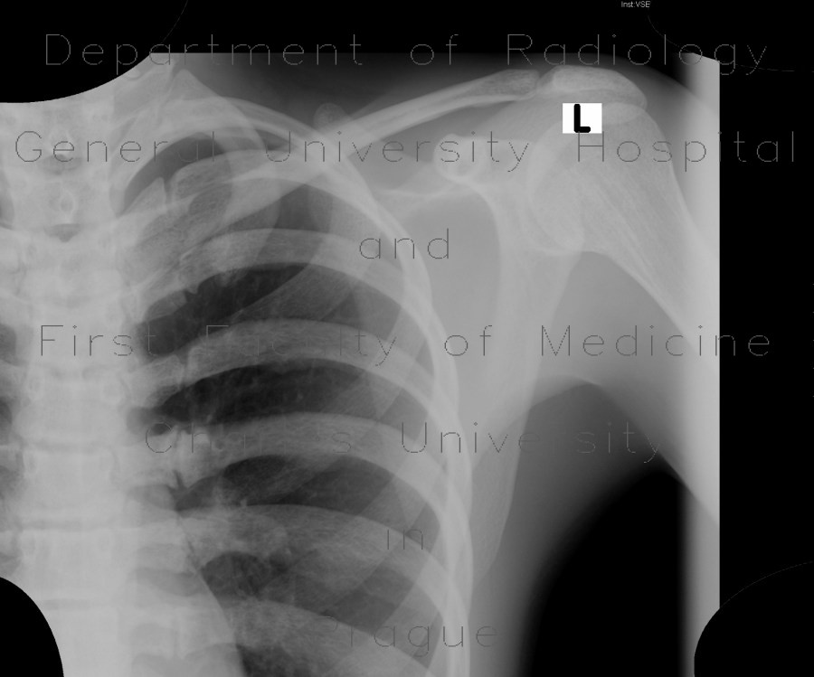 Osteopathia striata, systemic bone disorder