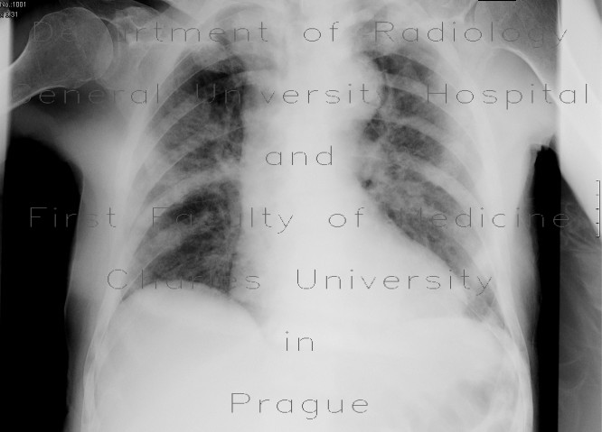Osteoplastic metastases