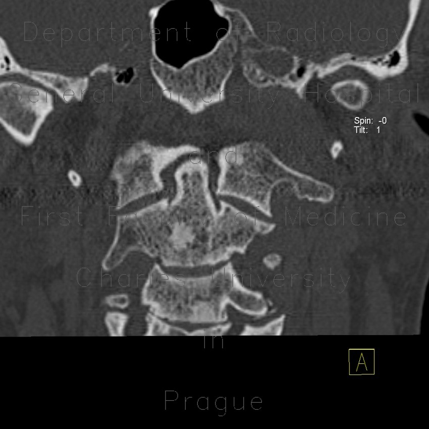 Radiology image - Osteoplastic metastasis of prostate cancer: Spine and Axial, Bone: CT - Computed tomography