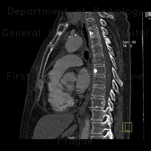 Radiology image - Osteoplastic skeletal metastases, breast carcinoma: Spine and Axial, Thorax, Bone: CT - Computed tomography