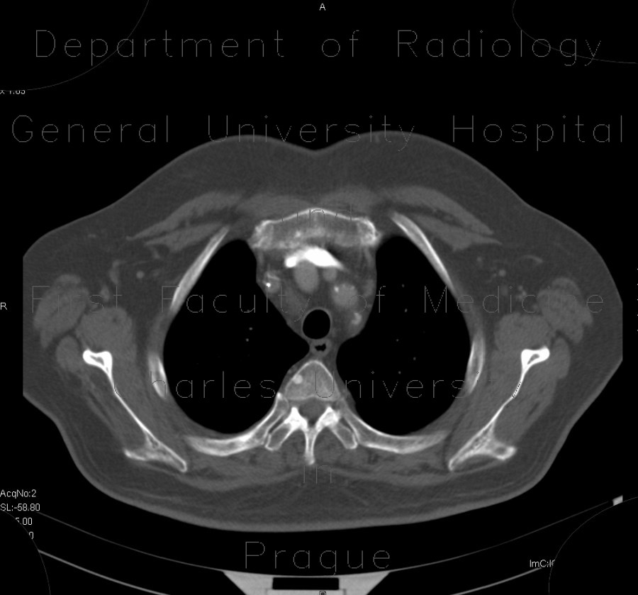 Osteopoikilosis, systemic bone disorder