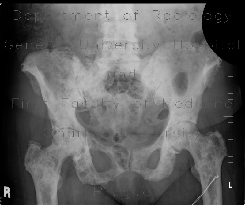 Osteosclerotic metastases of pelvis