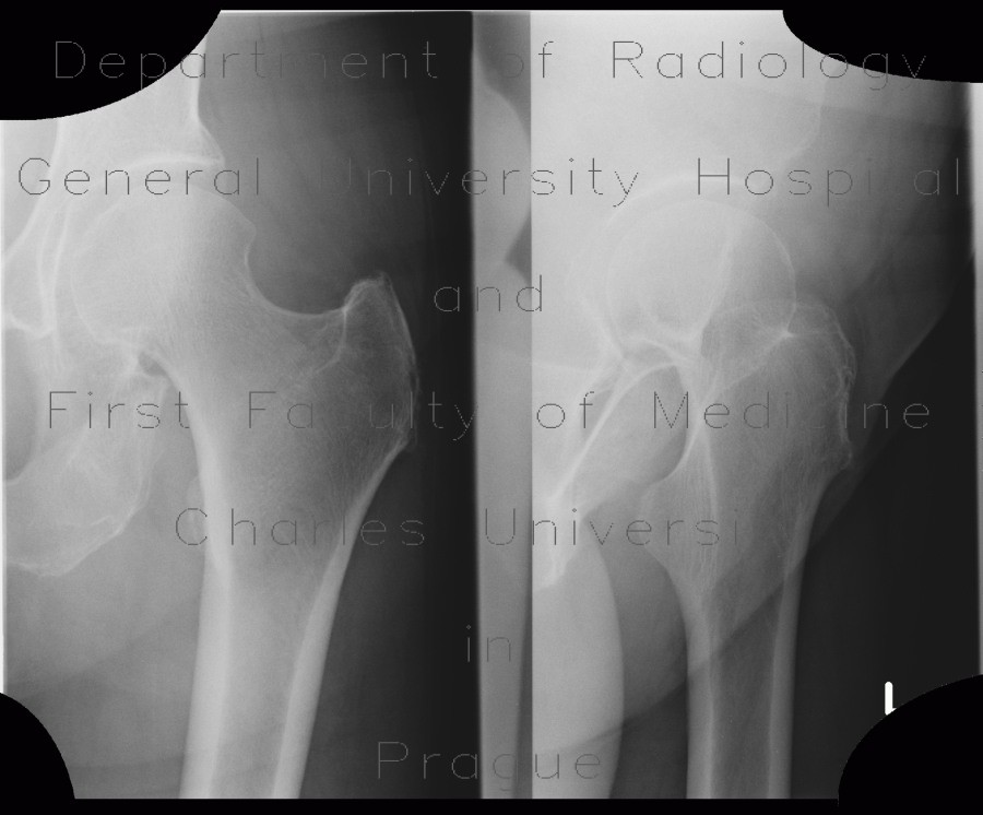 Outlines of gluteal muscles in the hip