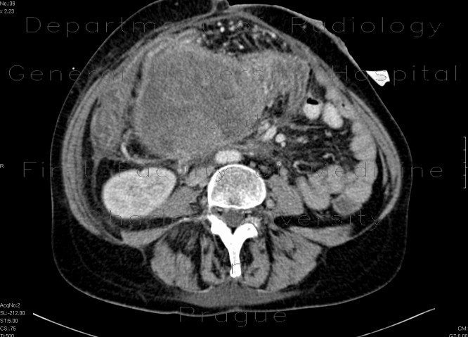 Radiology image - Ovarial carcinoma, peritoneal carcinomatosis: Abdomen, Gynecology, Peritoneal cavity: CT - Computed tomography