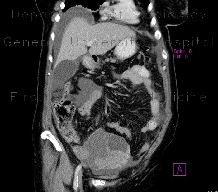Radiology image - Ovarian carcinoma, carcinomatosis: Abdomen, Gynecology, Peritoneal cavity: CT - Computed tomography