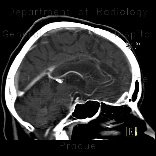 Pacchioni's granulation in sinus rectus