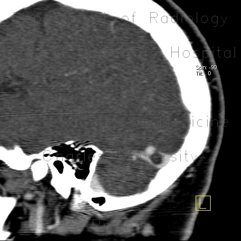 Pacchioni granulation in transverse sinus