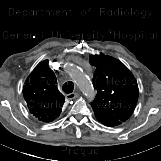 Radiology image - Pachypleuritis after talc pleurodesis: Thorax, Mediastinum and pleural cavity: CT - Computed tomography