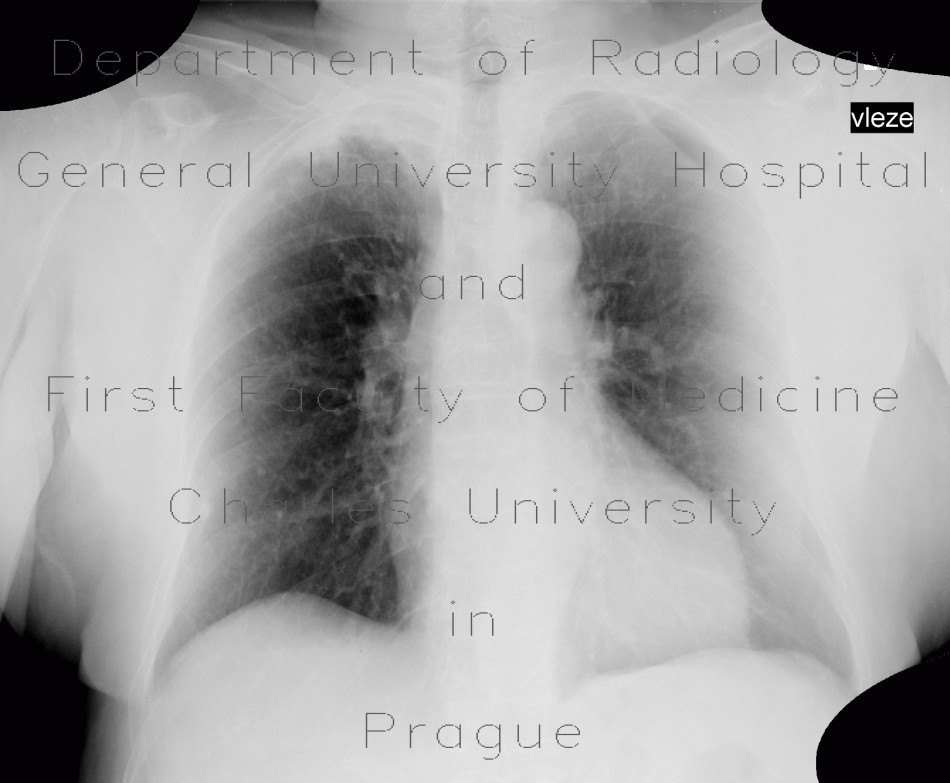 Pachypleuritis, apical