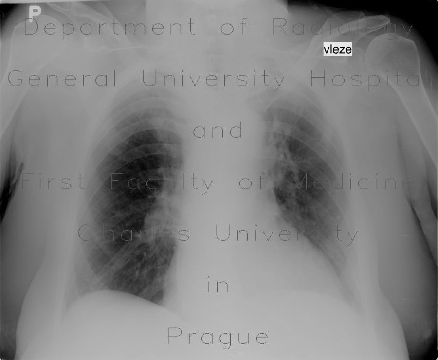 Pachypleuritis, apical, postspecific changes