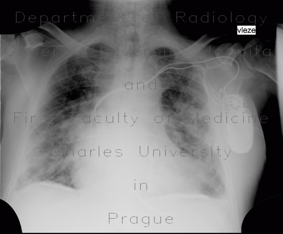 Pachypleuritis, calcified, pachypleuritis calcarea