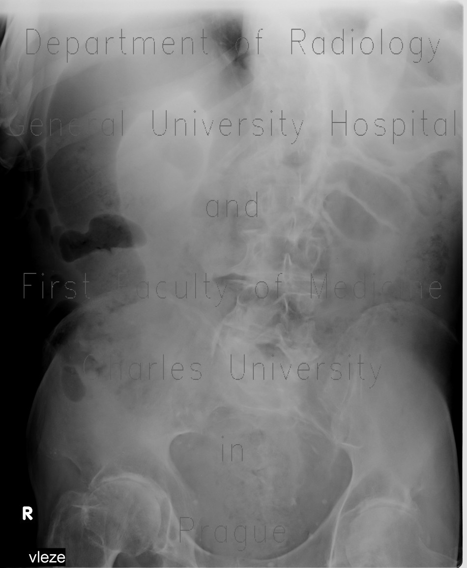 Pancolitis, colitis, severe