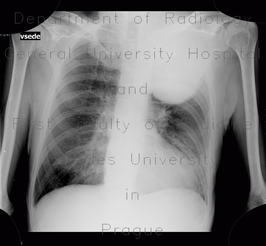 Pancoust tumor, extension into spine, lung cancer, pulmonary carcinoma