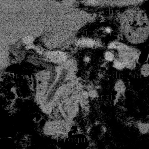 Pancreas divisum on CT, mininum intensity projection, MinIP