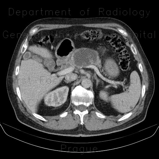 Radiology image - Pancreatic pseudocyst, pseudocyst in mesentery: Abdomen, Pancreas, Peritoneal cavity: CT - Computed tomography