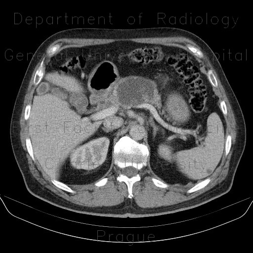 Pancreatic pseudocyst, pseudocyst in mesentery