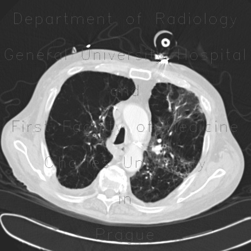 Panlobular emphysema