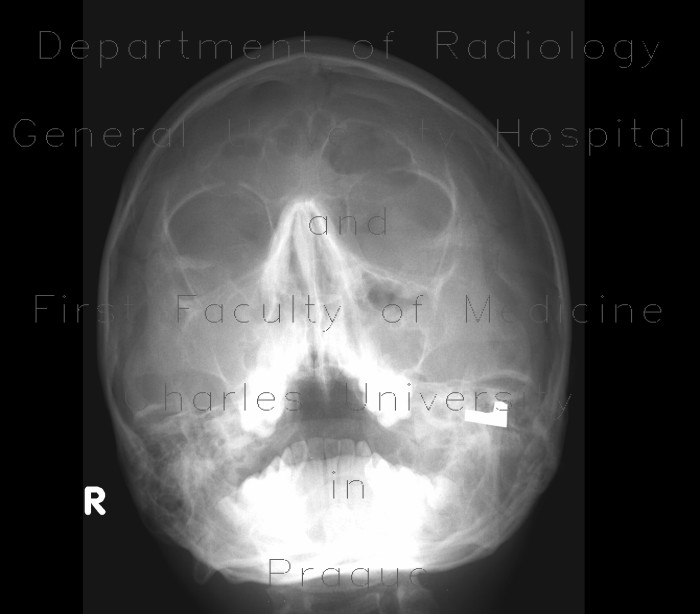 Pansinusitis