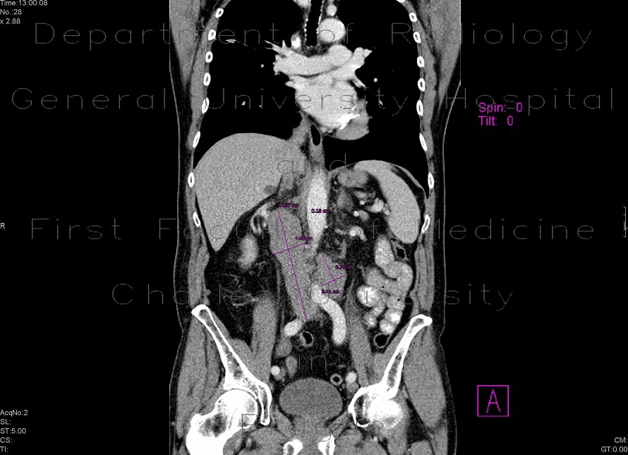 Paraaortic lymphatic mass, bulky
