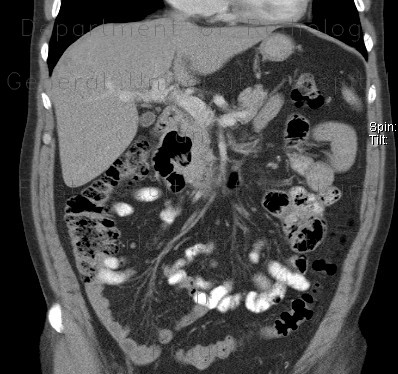 Parapapillary diverticulum of duodenum