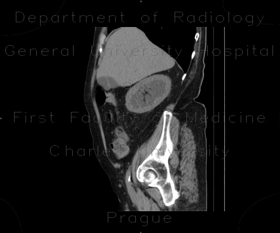 Radiology image - Parapelvic cysts, intrasinusoidal, central cysts: Abdomen, Kidney and adrenals: CT - Computed tomography