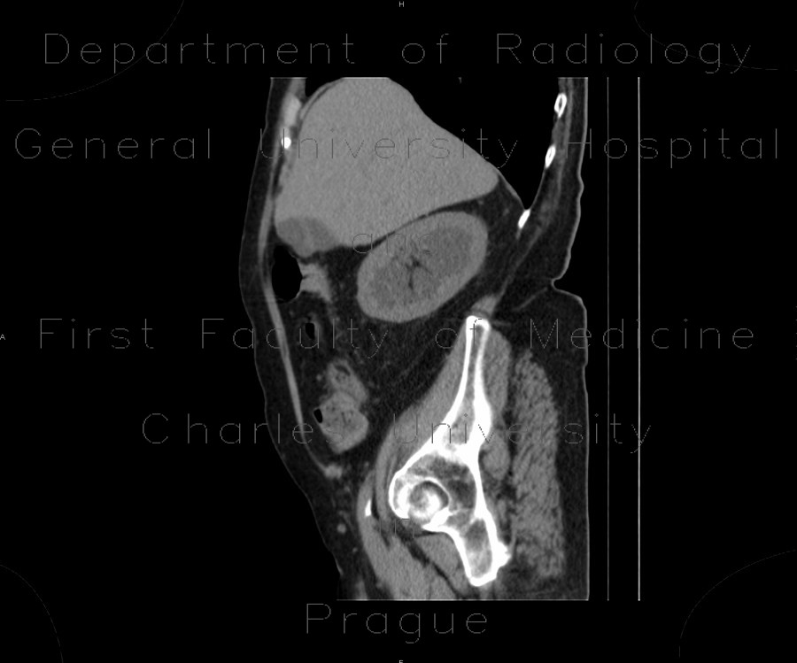 Parapelvic cysts, intrasinusoidal, central cysts