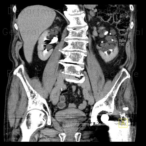 Parapelvic cysts of kidney, Paramo's syndrome