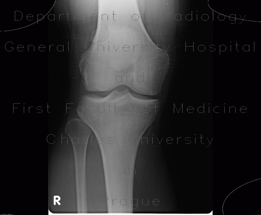 Radiology image - Patella bipartita, bipartite patella: Extremity, Bone: X-ray - Plain radiograph
