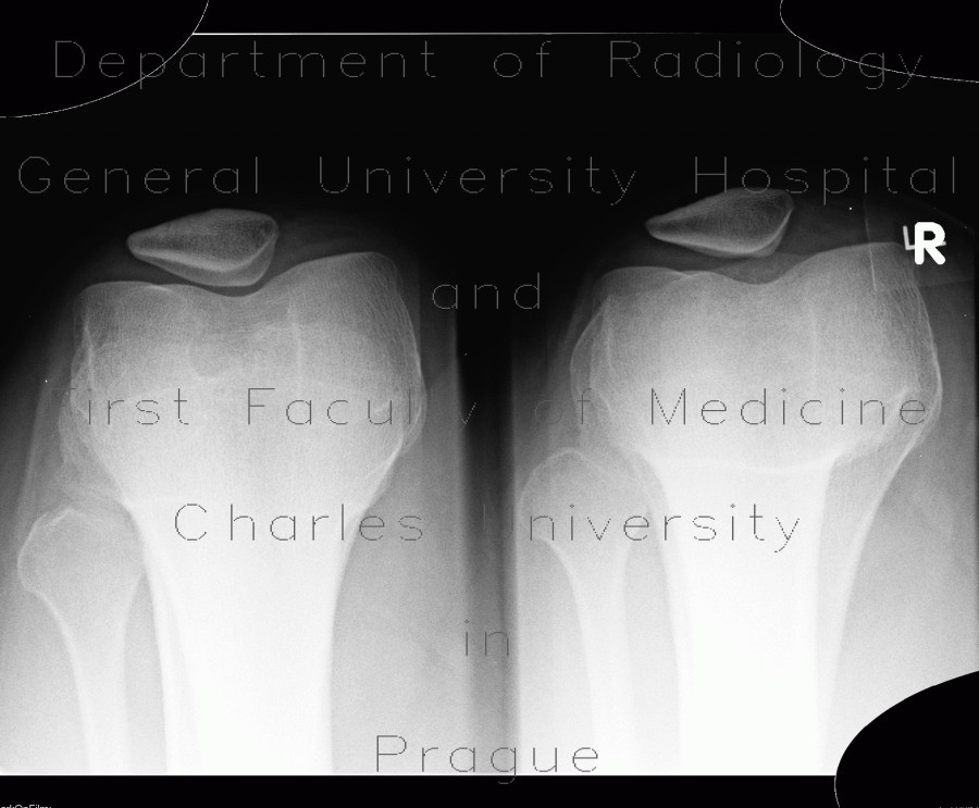 Radiology image - Patellar dysplasia, Wiberg III: Extremity, Bone: X-ray - Plain radiograph