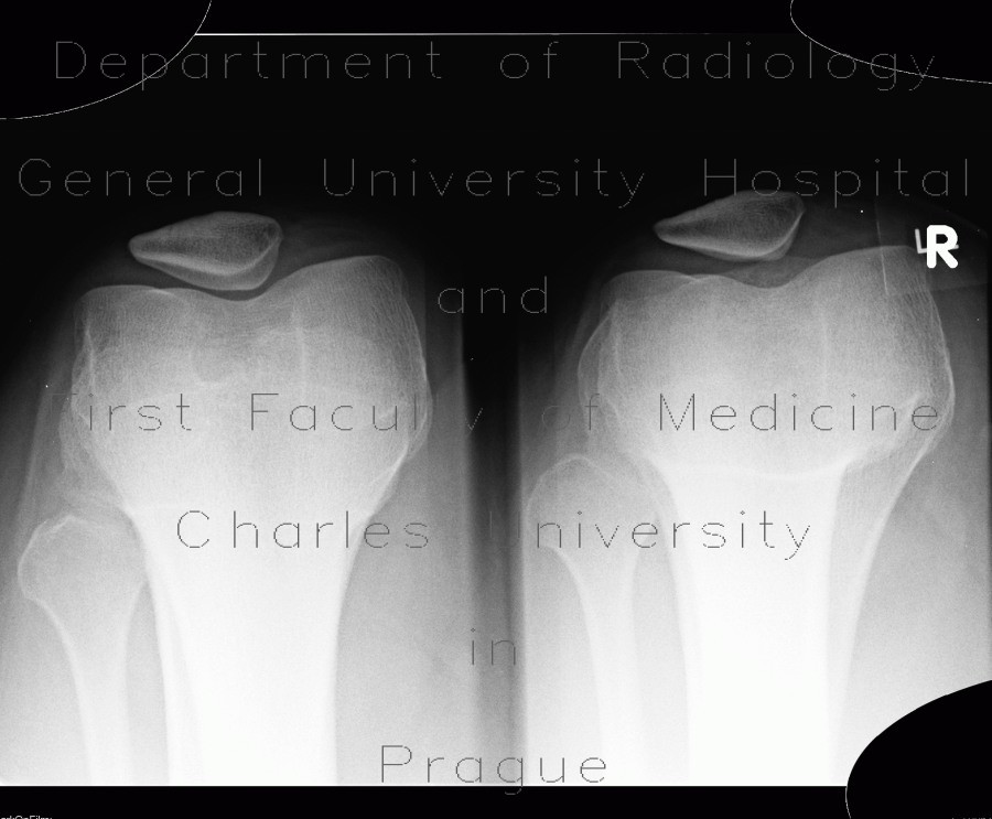 Patellar dysplasia, Wiberg III