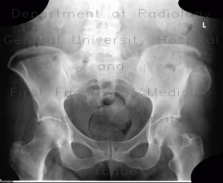 Pathologic fracture of pelvis