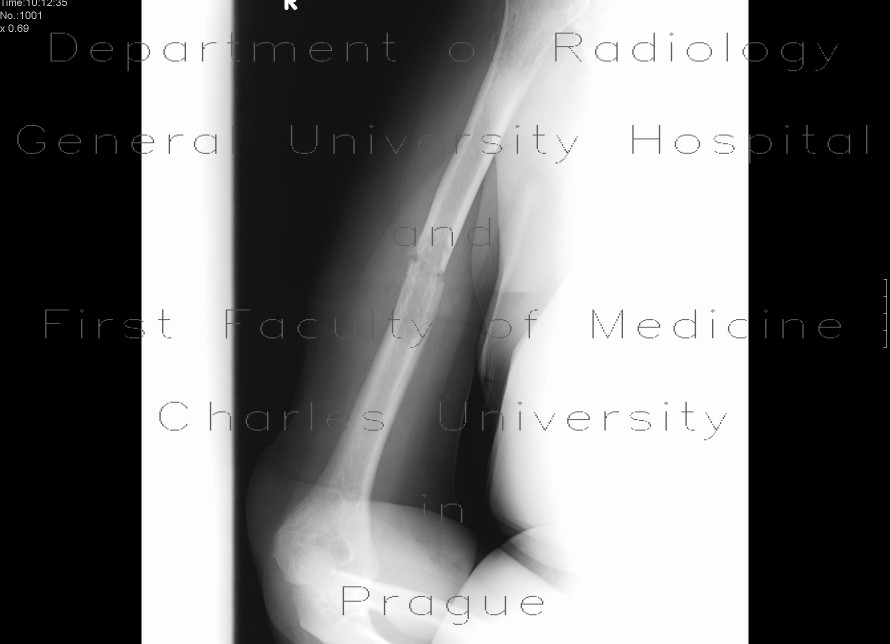 Radiology image - Pathological fracture of humerus: Extremity, Bone: X-ray - Plain radiograph