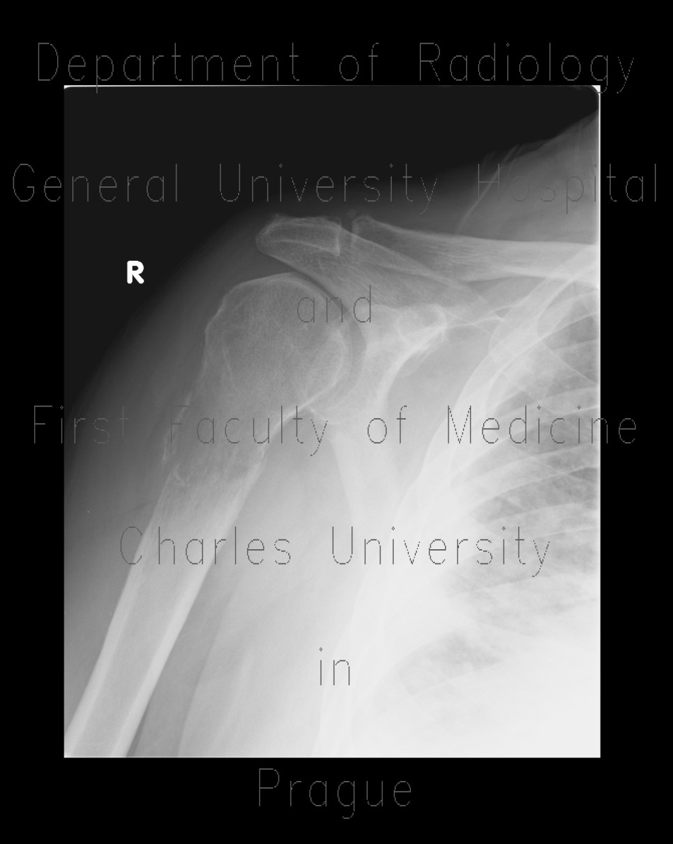 Pathological fracture of humerus, fracture