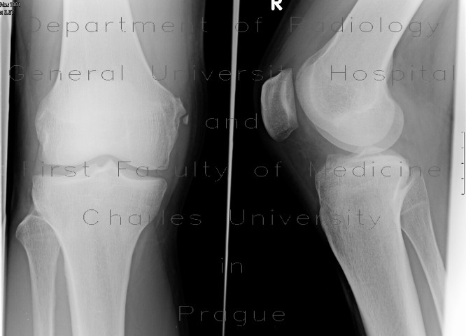 Radiology image - Pellegrini Stieda: Extremity, Bone: X-ray - Plain radiograph