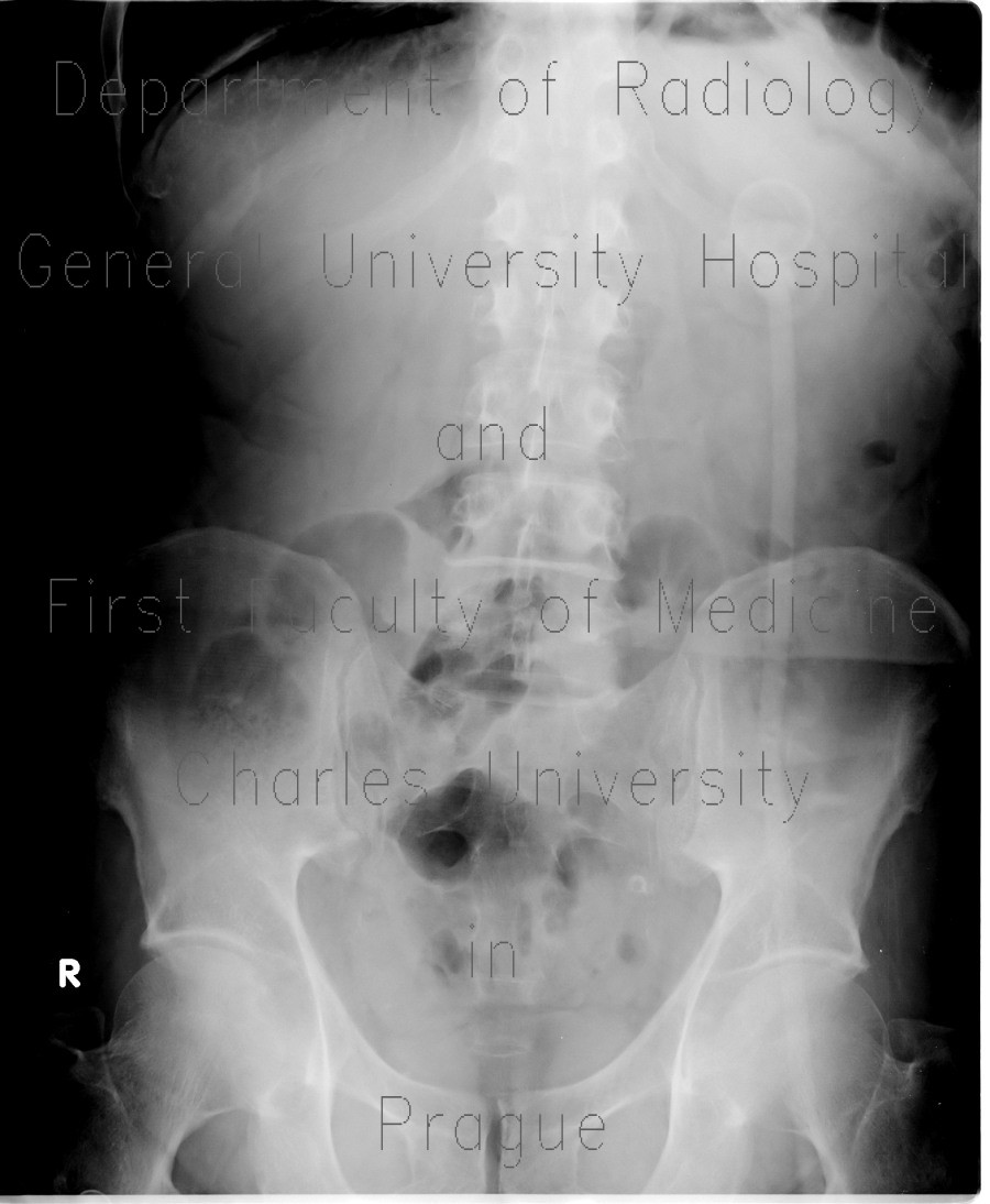Percutaneous endoscopic gastrostomy, PEG