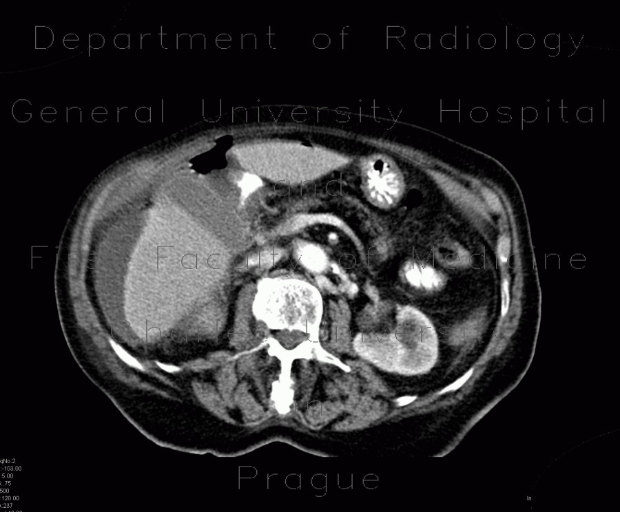 Radiology image - Perforation of gastric ulcer, stomach ulcer: Abdomen, Large bowel, Peritoneal cavity: CT - Computed tomography