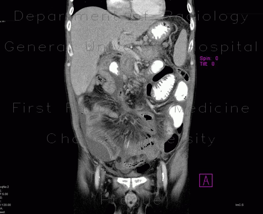 Perforation of ileum