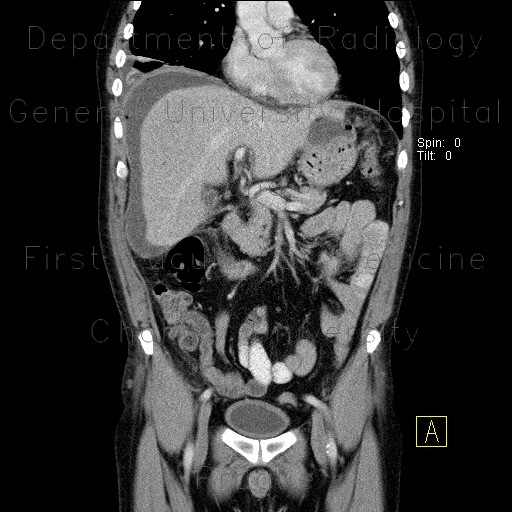 Radiology image - Perforation of peptic ulcer: Abdomen, Peritoneal cavity, Stomach: CT - Computed tomography