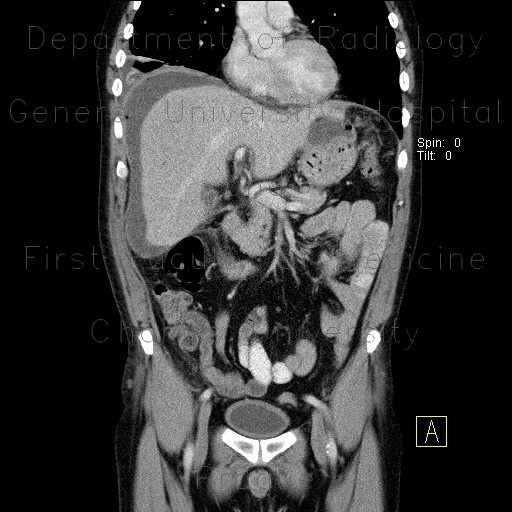 Perforation of peptic ulcer