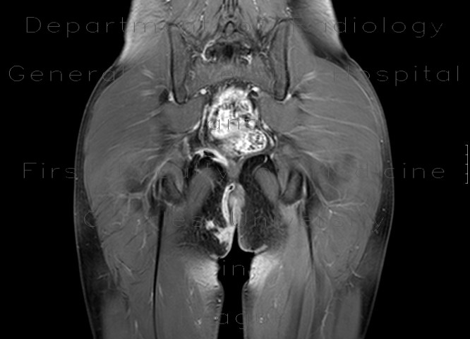 Radiology image - Perianal fistulae, Crohn