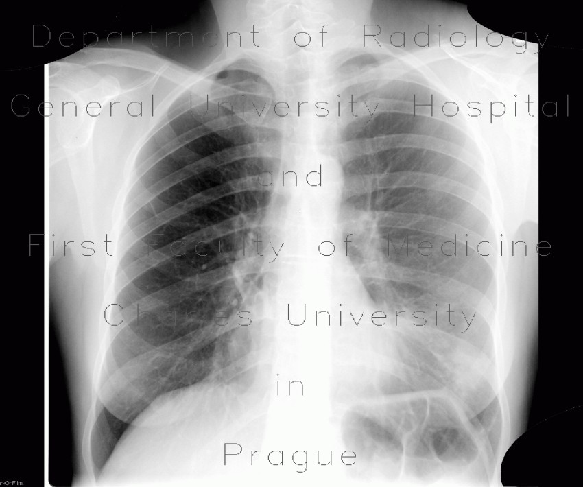 Peribronchitis