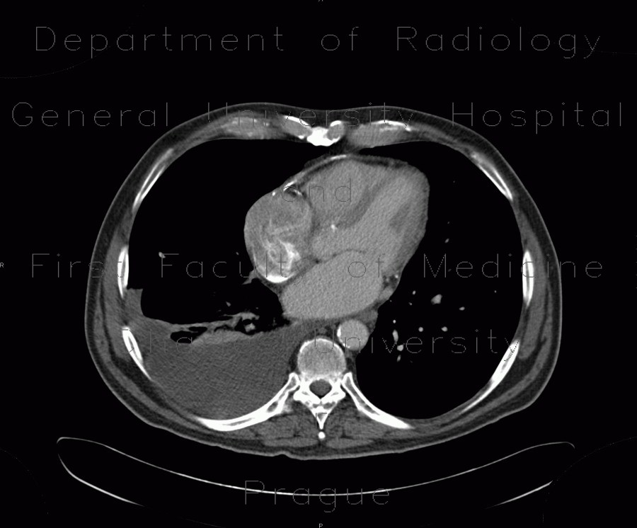Radiology image - Pericardial calcification, calcified pericarditis, pericarditis calcarea: Thorax, Heart: CT - Computed tomography