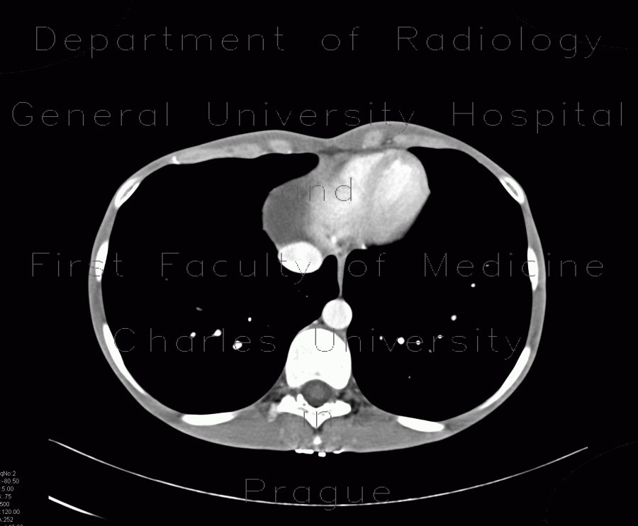 Pericardial cyst