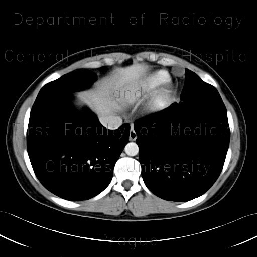 Radiology image - Pericardial cyst: Thorax, Heart: CT - Computed tomography